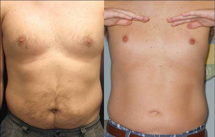 body contouring fat loss